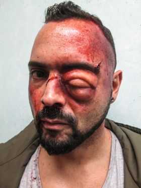 Párpado tan hinchado que cierra el ojo, con sangre en la sien y en la nariz